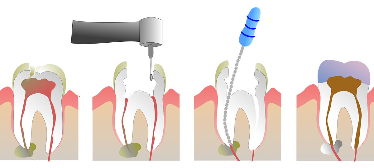 Root Canal Procedures in Buffalo, NY