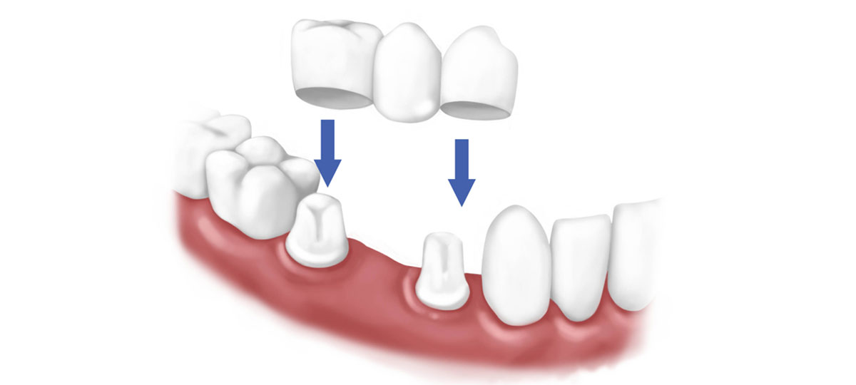 Dental Bridgework Services