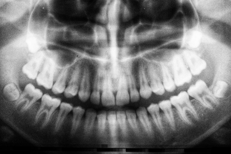 XRays Necessary, But Radiation Not So Much Brighton Family Dental