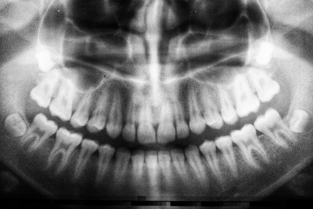 X Rays Necessary But Radiation Not So Much Brighton Family Dental