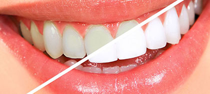 Teeth Whitening in Buffalo NY